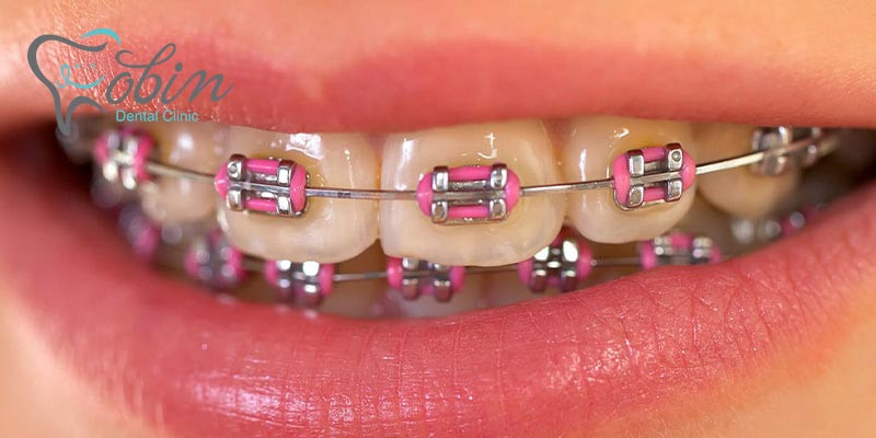 نگهداری دندان ها بعد از ارتودنسی